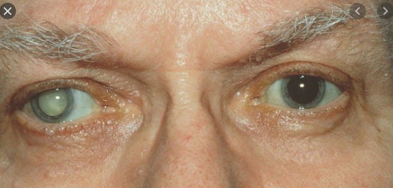 Y học: Mắt người già